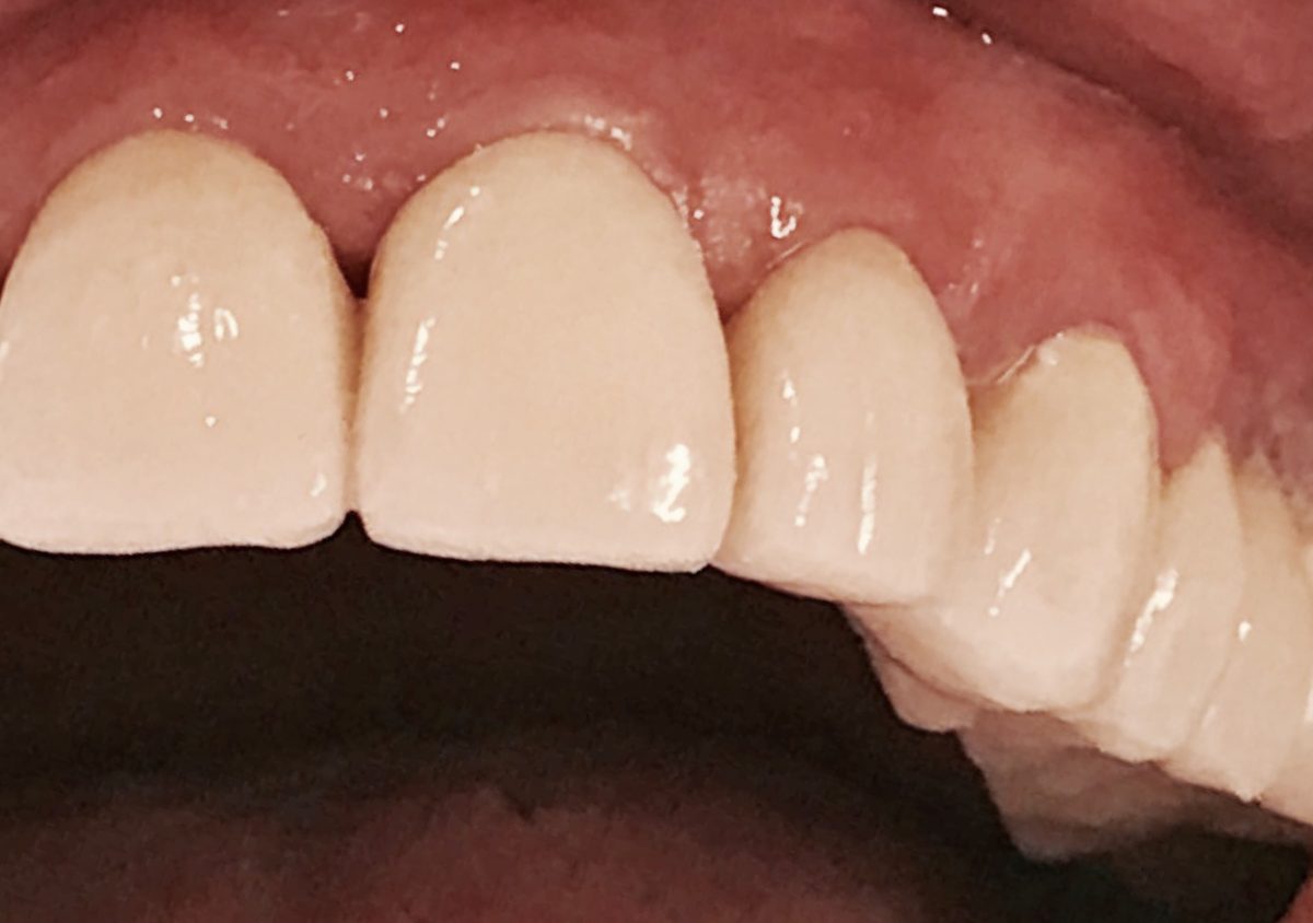 Rehabilitación fresada CAD/CAM