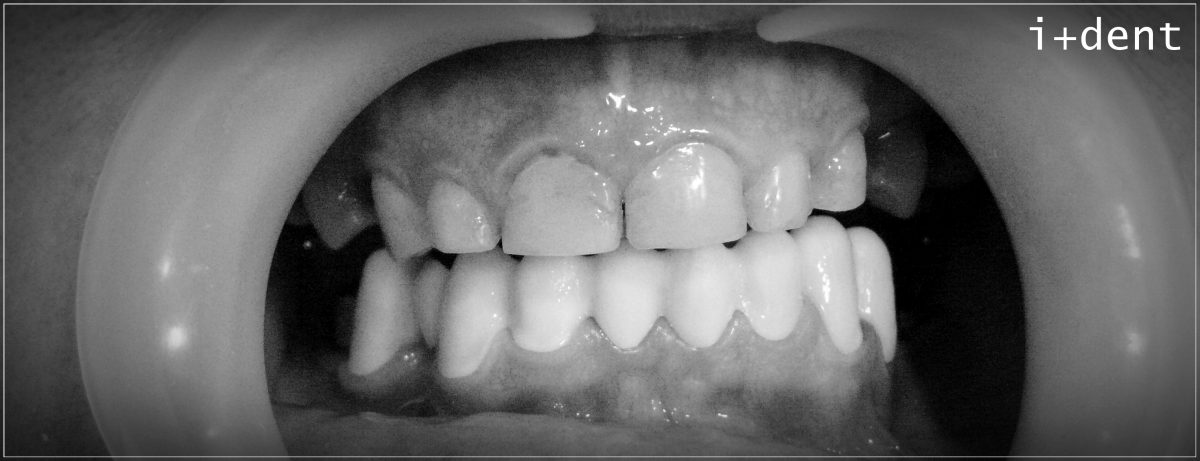 Zirconio: Ajuste perfecto. Perfecta elección 👌
