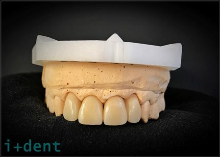 Disilicato de litio – Nuevo KIT de pastillas