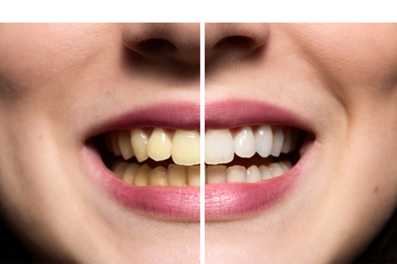Cómo alargar los resultados del blanqueamiento dental y lucir una sonrisa perfecta
